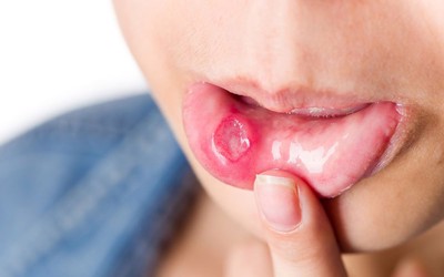 Bệnh chân tay miệng ở trẻ có biểu hiện loét miệng 